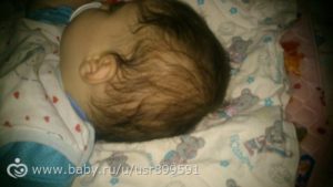 Ребенку 4 месяца выпадают волосы