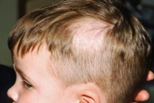 Ребенку 3 месяца волосы выпадают