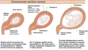 Как выглядит матка при беременности на ранних сроках фото