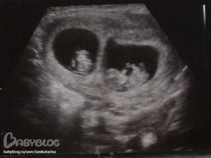 Двойня 12 недель беременности фото узи