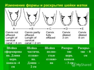 Раскрытие шейки матки на 2 пальца сколько это сантиметров