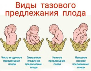 23 Недели беременности тазовое предлежание