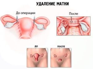 Гормонозаместительная терапия после удаления яичников и матки