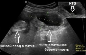 Можно Ли Определить На Узи Внематочную Беременность