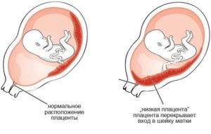 Низкая плацентация при беременности 33 34 недели