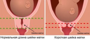 Прострелы в шейке матки при беременности