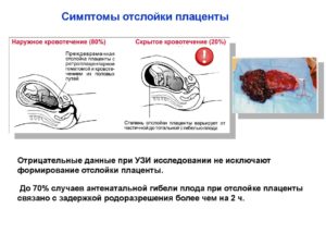 Отслойка плаценты 39 неделе беременности