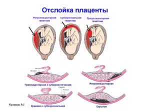 Отслойка и гематома плаценты на ранних сроках беременности