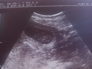 Признаки замершей беременности на 15 неделе