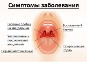 Горло Красное У Ребенка Чем Лечить Отзывы