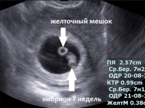 Желточный мешок есть а эмбриона не видно 6 недель