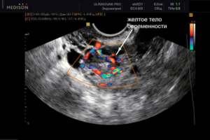 Желтое тело 9 неделе беременности