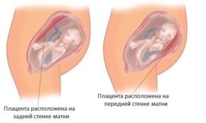 Плацента по задней стенке матки с переходом на дно