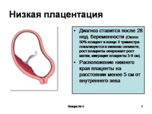 Низкая плацентация при беременности 22 неделя