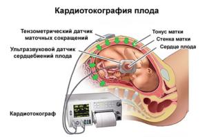 Сколько лежат в больнице с тонусом матки при беременности