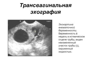 8 Недель внематочной беременности