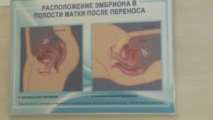 Подсадка эмбрионов при эко на 5 день отзывы