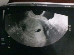 Двойня узи 5 недель беременности фото