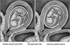 Раскрытие внутреннего зева при беременности 20 недель