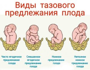 31 неделя беременности тазовое предлежание перевернется или нет