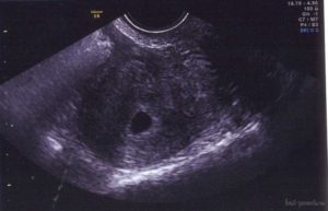 3 недели от зачатия узи покажет беременность