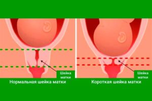 Мягкая Шейка Матки При Беременности 24 Недели