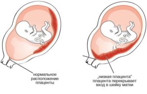 Низкая плацентация 17 недель беременности