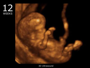 Фото 3д узи на 12 неделе беременности