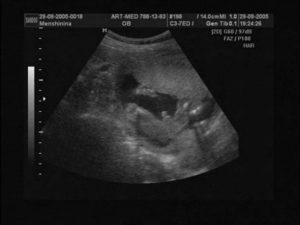 Фото узи на 20 неделе беременности мальчиков и девочек