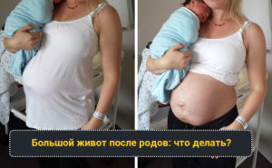 После родов большой живот почему