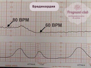 Как Разбудить Ребенка В Животе Перед Ктг