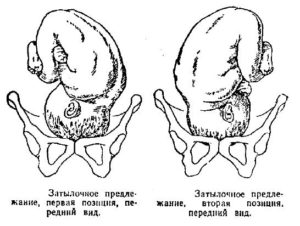 Положение плода продольное предлежание головное 1 позиция передний вид