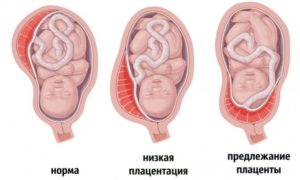 Низкая плацентация при беременности 33 34 недели