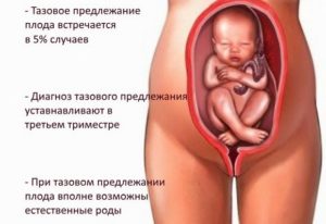 Тазовое предлежание плода в 28 недель