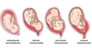 Низкое расположение плода при беременности причины и как поднять