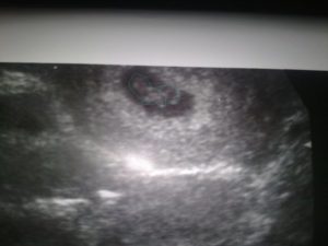 7 Неделя беременности двойней