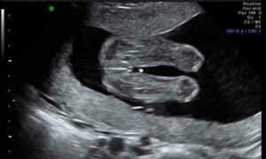 Видно ли пол на 16 неделе беременности