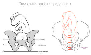 Опущение головки плода в малый таз ощущения