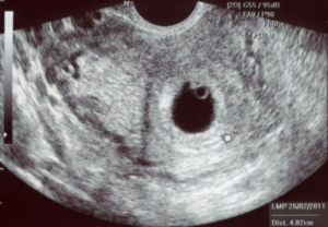 Плодное яйцо 14 мм эмбрион не визуализируется