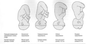 Низко расположена головка плода на 30 неделе