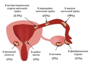 Растет матка при внематочной беременности