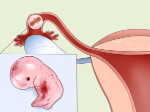 Всегда Ли Удаляют Трубу При Внематочной Беременности