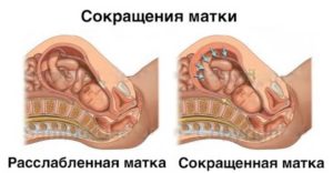 Сколько лежат в больнице с тонусом матки при беременности