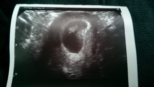 Тонус матки первый триместр. УЗИ гипертонус 7-8 недель. Тонус на 9 неделе беременности. Гипертонус матки при беременности 1 триместр.