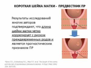 Короткая Шейка Матки На 30 Неделе Беременности