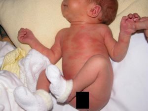 Токсическая Эритема У Новорожденных Причины И Последствия