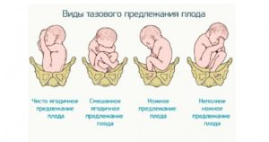 Тазовое предлежание плода на 30 неделе беременности причины и последствия