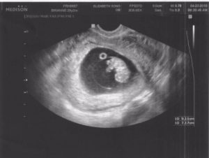 9 Недель и 2 дня беременности форум