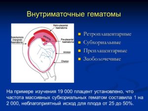 Гематома при беременности в стадии организации что это