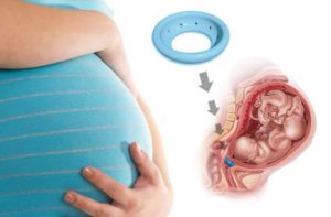 Больно ли ставить кольцо на шейку матки при беременности